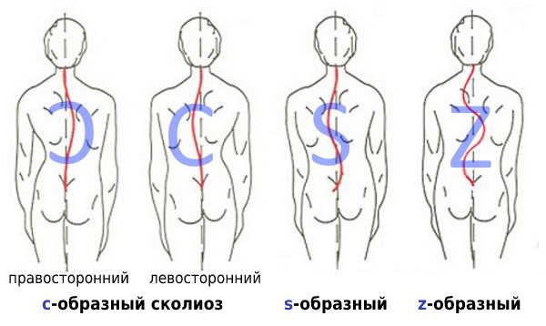 image-23-02-24-05-52 Сколиоз: степени, виды, причины, алгоритм коррекции | Доктор МАЗИТОВА  / Онлайн-школа здоровья