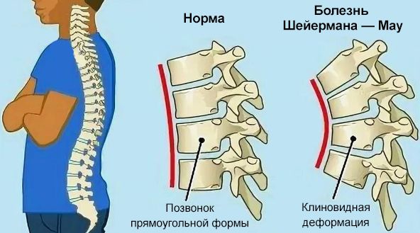 image-23-02-24-05-53 Сколиоз: степени, виды, причины, алгоритм коррекции | Доктор МАЗИТОВА  / Онлайн-школа здоровья