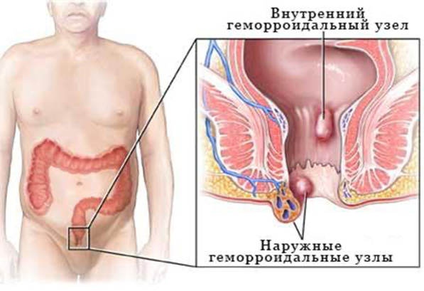 images-jeludok Геморрой: как не лечить, а вылечить? | Доктор МАЗИТОВА  / Онлайн-школа здоровья