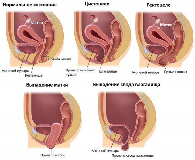 opuchenie-1 Слабость тазового дна: как предотвратить дальнейшее опущение матки? | Доктор МАЗИТОВА  / Онлайн-школа здоровья
