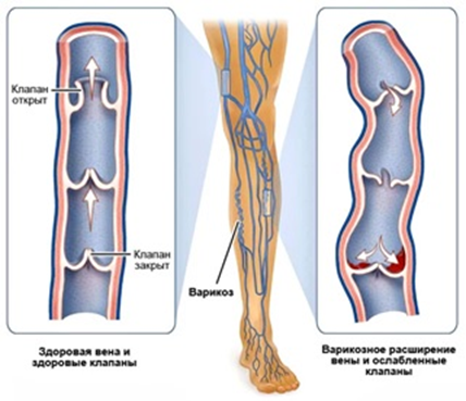 varicoz-1 Почему при варикозе ног не поможет операция | Доктор МАЗИТОВА  / Онлайн-школа здоровья